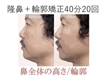 ラプリ 梅田店(Raplit)/隆鼻＋輪郭矯正40分20回