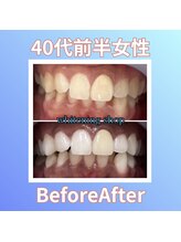 ホワイトニングショップ 西原店/40代前半女性☆BeforeAfter