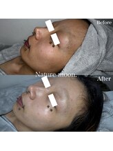 ナチュールムーン(Nature moon.)/ハーブピーリング after