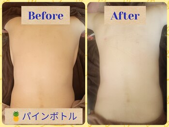 サロンド ベレーゼの写真/今話題のパインボトルで脂肪縮小ケアをして体のくびれや二の腕、足、フェイシャルなど２0分かけてひきしめ