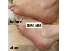 安立鍼灸整骨院の雰囲気（角質ケアの施術1回目（個人差あり））