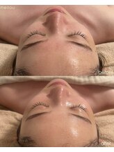 メロウ(mellou)/before /after