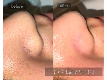 ル シーニュ/うぶ毛詰まり20代