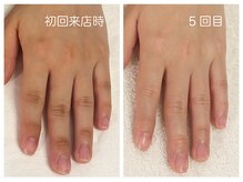 キレイテ 上野店/30代/5回目【ハンドケア上野】