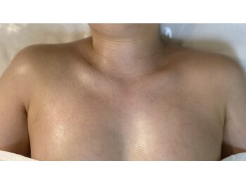 フォー(For...)/バストアップ施術後