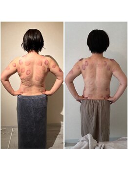 ビレイ(Birei)/カッサ＋カッピング