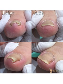 巻き爪補正店 那覇店/