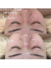 アキュモンド 渋谷院(acumond)/セラピール施術1回での変化