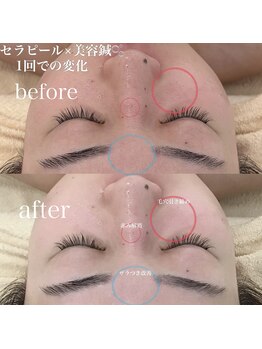 アキュモンド 渋谷院(acumond)/セラピール施術1回での変化