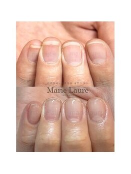 深爪矯正/自爪育成/ネイルケア