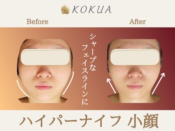 痩身専門店エステティックサロン コクア(KOKUA)/ハイパーナイフ×デコルテリンパ