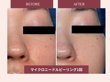 セレブヒルズ 札幌本店(Celeb Hill's)/マイクロピーリング1回目