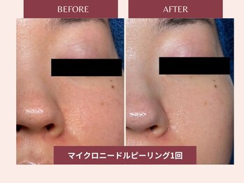 セレブヒルズ 札幌本店(Celeb Hill's)/マイクロピーリング1回目
