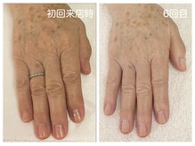 キレイテ 上野店/60代/6回目【ハンドケア上野】