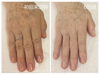 キレイテ 上野店/60代/6回目【ハンドケア上野】
