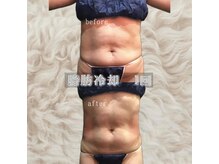 プリマプリート WEST店/脂肪冷却体験１回★お腹４カップ