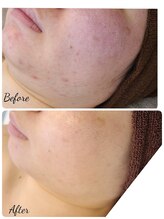 サロン ド ハニー(Salon de Honey)/ハーブピーリング