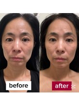 サロンチオリ 烏丸(Salon Chiori)/《60代》左右差整う小顔矯正