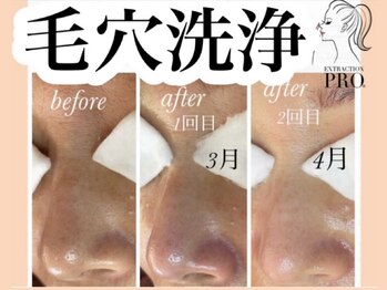 ナチュリー(Natully)/毛穴改善ケア