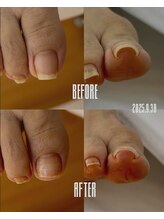 おん/巻き爪補正B/Sスパンゲ