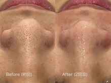 ウルト アルティメイトスキン(ULT ultimate skin)/before after