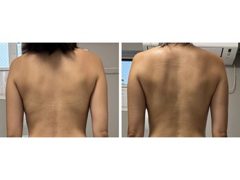 リクラ 北千住(Reclat)/1回ビフォーアフター