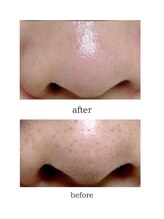 サロン リノ(salon rino)/毛穴もらめだたなくなる