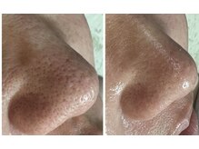 エステサロン オパール(OPALE)の雰囲気（肌管理  小鼻の黒ずみ ボコボコ毛穴洗浄パックでツルスベ肌）