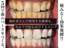 ジェントルメンズグロー(Gentlemen’s Glow)/【セルフホワイトニング】
