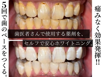 ジェントルメンズグロー(Gentlemen’s Glow)/【セルフホワイトニング】