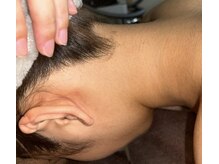 ベルフィオーレ(bel fiore)/10代女性　1ヶ月後　After