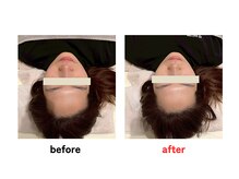 四条大宮アシスト鍼灸整骨院/美容鍼ビフォーアフター