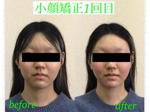オズ六本木/小顔モニター様小顔矯正1回目