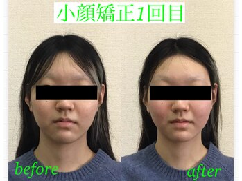 オズ六本木/小顔モニター様小顔矯正1回目