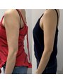 ミリュール(Millule)&nbsp;顔だけでなくボディーのリフトアップ＆たるみも。2回の変化です