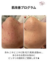 メゾンリュバン 天王寺(Maison Ruban)&nbsp;炎症ニキビ 毛穴