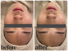エヌインスキンケアスタジオ 天神店 N-inスキンケアスタジオ/症例【美肌/美白/小顔/毛穴】