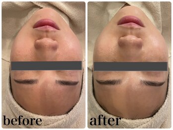 エヌインスキンケアスタジオ 天神店 N-inスキンケアスタジオ/症例【美肌/美白/小顔/毛穴】