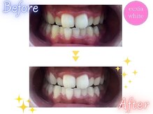 エクシアホワイトニング 武蔵小杉店/ビフォーアフター