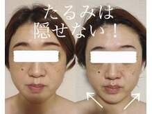 エクレクティック(ECLECTIC)/小顔/宇都宮フェイシャル