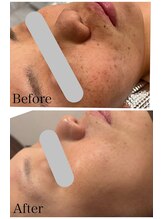 なごみ/最新◆プラズマフェイシャル4回