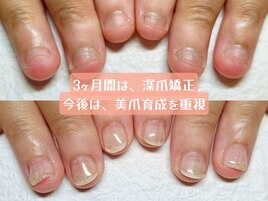 深爪が美爪になるまでの道のり