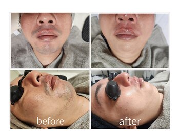 キレイラボ(Ki-Re-i LABO)/ヒゲ脱毛 メンズ