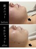 【リピーター様&セット限定】セルショットモニター【顎下脂肪ケア】¥3500