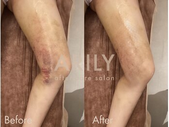 アリリィ(ARILY)/ダウンタイムケア/表参道/外苑前