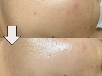 レナータ(RENATA)/ララピール/before after