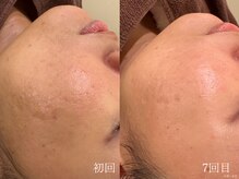 ウォーム(warm)/毛穴/毛穴洗浄/毛穴ケア/毛穴