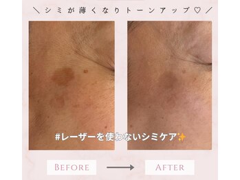 アマリー(Amary)の写真/【初回￥5,500～】気になるシミに◎ 年齢を感じさせない透明感あふれる素肌へ♪