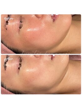 ファビリス 天王寺店(FAVILIS)/ACトリートメント1回/30代