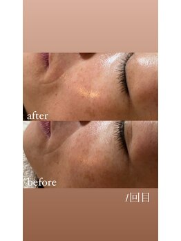 リュミエール(LUMIERE)/深い気になるほうれい線に◎